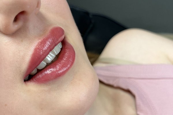 Subtle lip micropigmentation